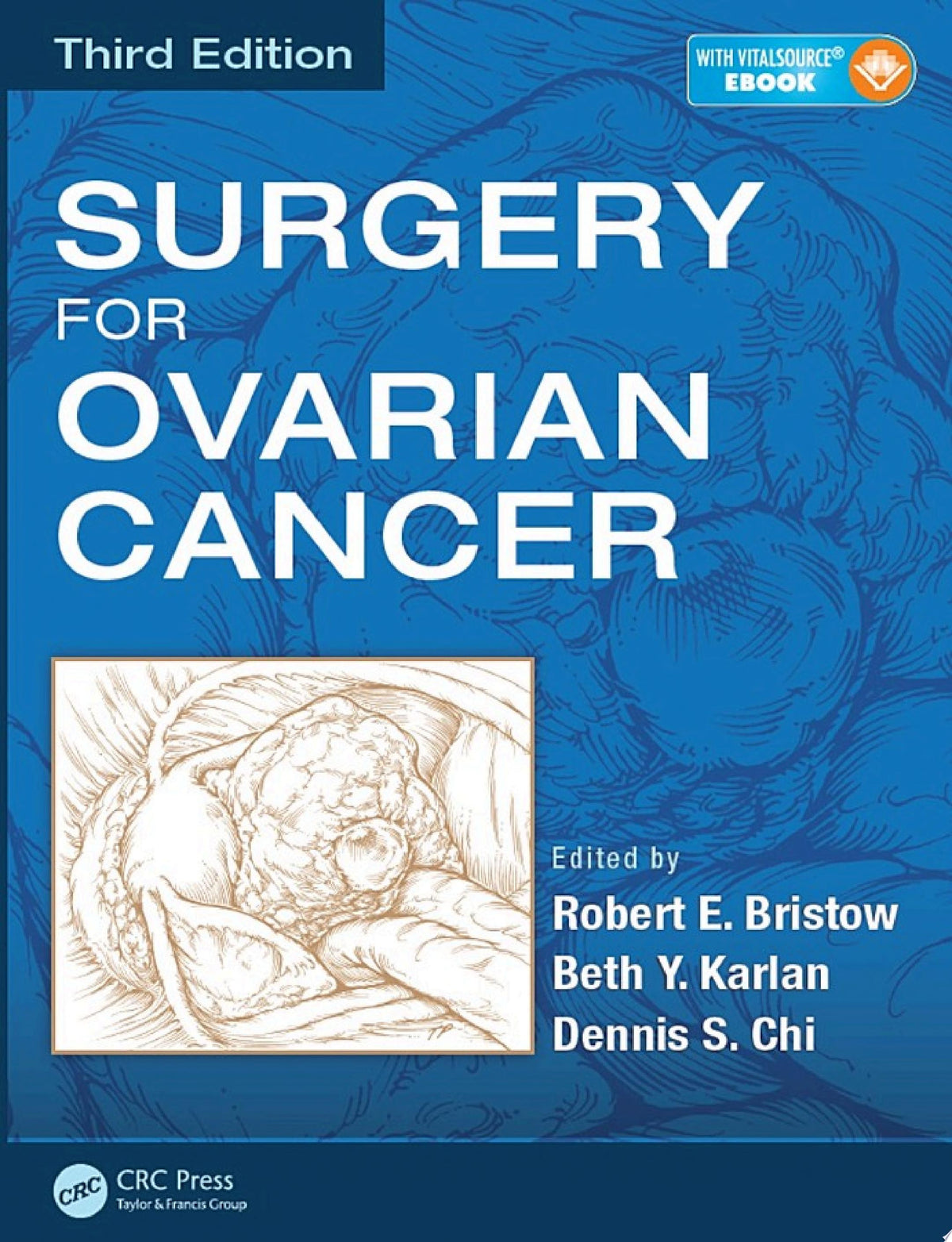 Surgery for Ovarian Cancer, Third Edition