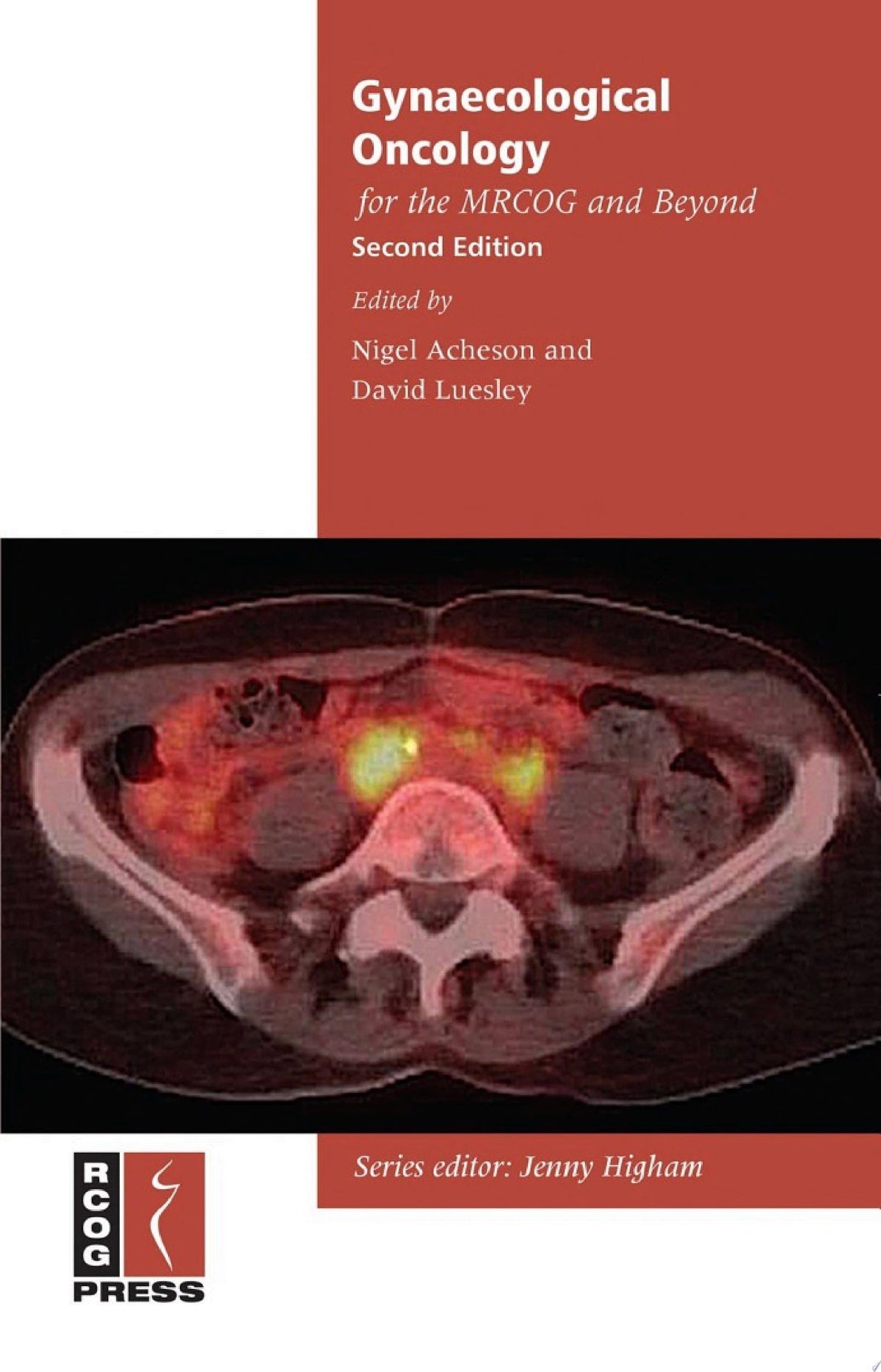 Gynaecological Oncology for the MRCOG and Beyond, 2nd Edition