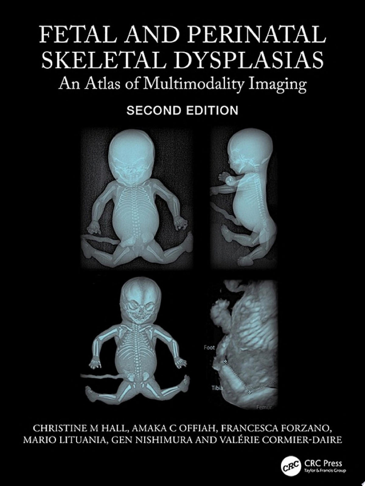 Fetal and Perinatal Skeletal Dysplasias: An Atlas of Multimodality Imaging 2e